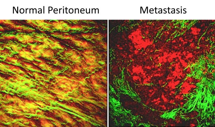 normal and metastatic multiphoton microscopy images