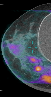This is a picture of a CT image taken with dedicated breast CT overlayed with a PET scan to reveal areas of high metabolism signaling several tumors