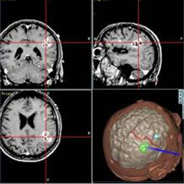 Three MRI image slices of a brain and one three dimensional image of a brain
