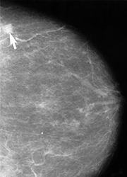 This is an image of a mammogram showing a small cancerous lesion