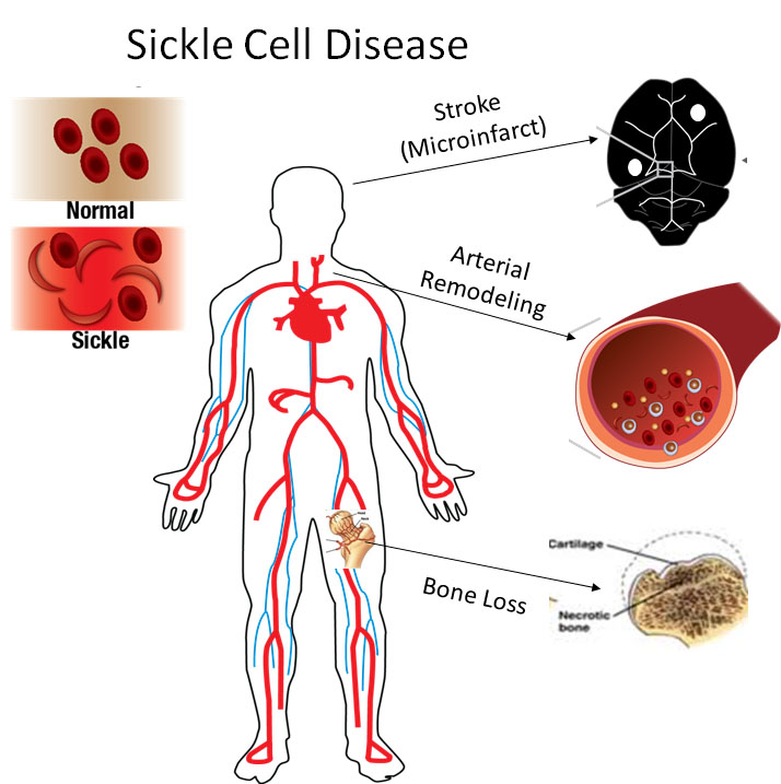 A diagram of the human body’s circulatory system with two images to the left depicting circular blood cells labelled Normal and a mix of circular and crescent shaped cells labelled Sickle. To the right three arrows point from the head of the body to an image of the brain, labeled Stroke (Microinfarct), from the neck to a cross-sectional image of an artery, labeled Arterial Remodeling, and from the hip joint to an image of the femoral head, labeled Bone Loss. 