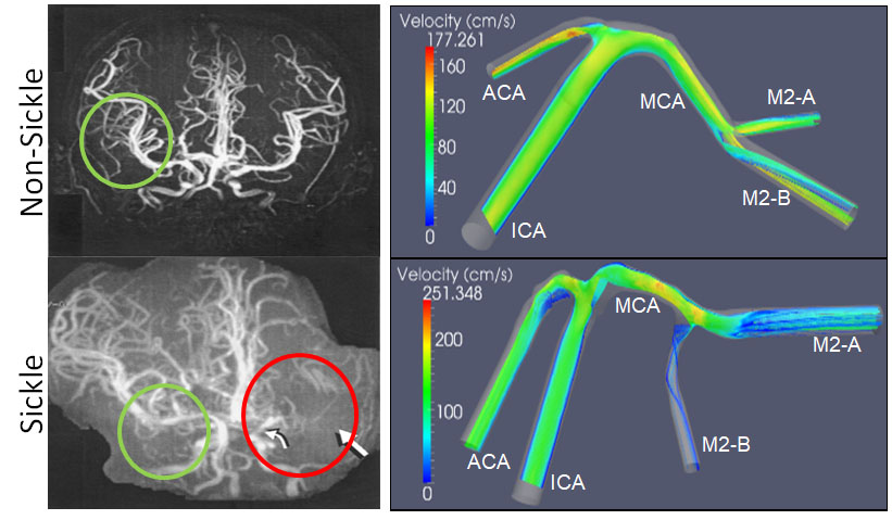 Two rows of two images each. To the left, the top row is labeled Non-Sickle and the bottom is labeled Sickle. The two leftmost images depict MRI images of the brain’s vasculature. Overlayed circular graphics mark similarities and differences between the two. The two rightmost images depict heat maps that show the speed of fluid flow within cerebral blood vessels. 